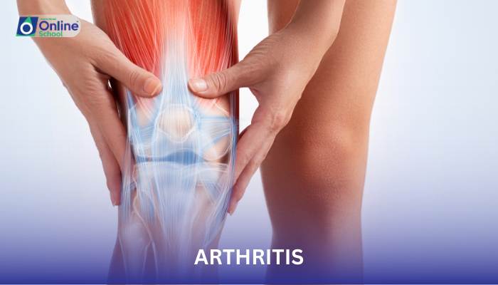 Lesson 11: Arthritis: Causes and Management